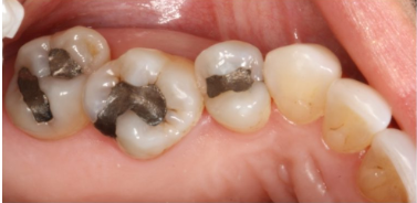 several caps on teeth inside someone's mouth