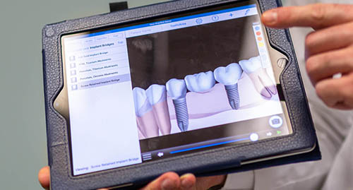 A dentist holds a tablet showing how tooth implants work