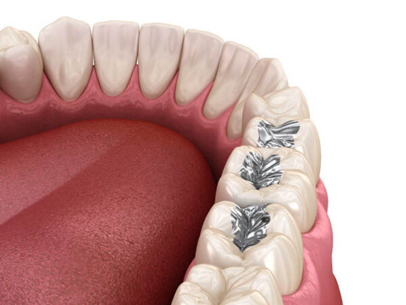 Amalgam restoration. Medically accurate 3D animation of dental concept